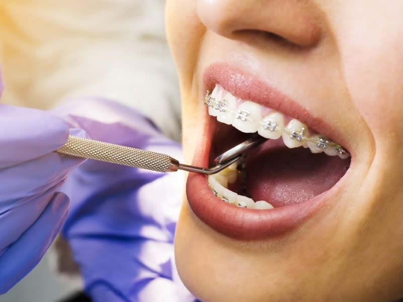 Diş Teli Takıldıktan Sonra Nelere Dikkat Edilmeli?